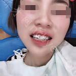 北京劲松口腔医院张丁牙齿矫正案例展示