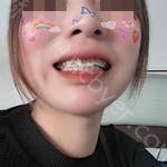 北京劲松口腔医院张丁牙齿矫正案例展示
