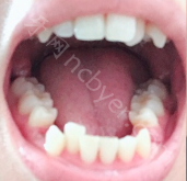 中山大学附属第三医院口腔科艾虹牙齿矫正真实案例分享