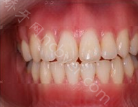 中山大学附属第三医院口腔科艾虹牙齿种植真实案例分享