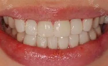 重庆牙博士口腔医院文林牙齿矫正真实案例分享