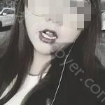 武汉皓诺口腔门诊部朱友家牙齿矫正案例分享