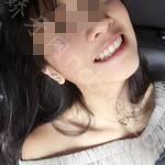 武汉第一口腔医院黄薇牙齿矫正案例分享