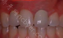湖南省人民医院马王堆院区口腔科张特牙齿种植案例