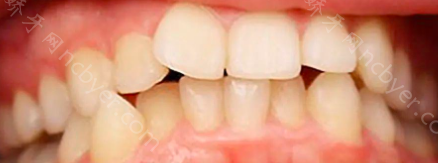 重庆韩佳牙博士口腔医院王默涵隐形牙齿矫正真实案例分享