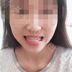 武汉市中心医院口腔科苏建牙齿矫正案例