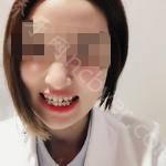 武汉市中心医院口腔科程志刚牙齿矫正案例
