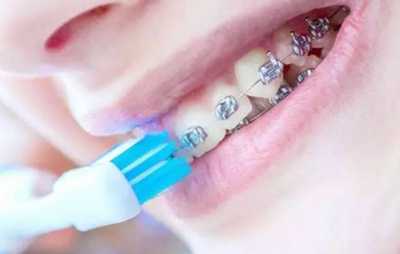 牙套一般带几年？为什么戴那么久？