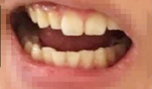 重庆贝尔口腔洗大概需要多少钱？重庆贝尔口腔医院洗牙前后对比！