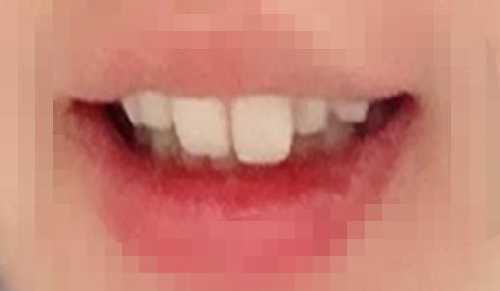 重庆贝尔口腔洗大概需要多少钱？重庆贝尔口腔医院洗牙前后对比！