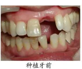 上海圣贝口腔门诊王申牙齿种植真人正案例分享