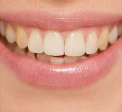 长沙市口腔医院段亚光做牙齿美白手术案例分享