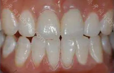 杭州亮贝美口腔医院李诗佩做牙齿种植的案例分享