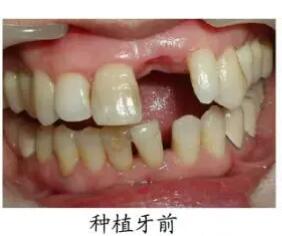 上海尤旦口腔医院王冬玉牙齿治疗案例分享