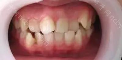 杭州齐尔口腔门诊吴叶群做牙齿矫正案例分享