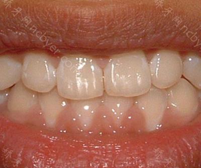 杭州齐尔口腔门诊柯可牙齿正畸术前后对比