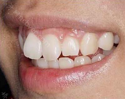 杭州瑞创口腔门诊邢磊做牙齿矫正的案例分享