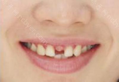 杭州余杭口腔医院李德芳做牙齿种植术前术后分享
