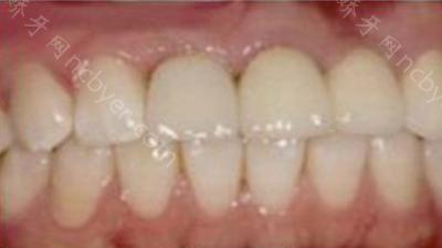 杭州余杭口腔医院孟祥龙做牙齿种植的术前后照片对比
