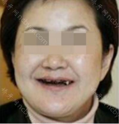 杭州余杭口腔医院陈姿燕做牙齿种植术前后分享