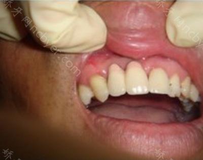 杭州北乐口腔门诊蔚乐乐牙齿种植案例分享