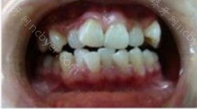 杭州格莱美口腔医院蓝海慧做牙齿矫正术前后案例分享