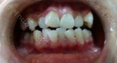 杭州北乐口腔门诊江小亮做牙齿矫正的案例分享