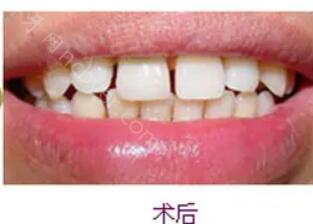 上海国际医学中心口腔科方早做烤瓷牙案例展示