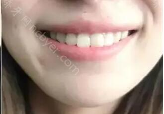 上海长海医院口腔科周中华做牙齿美白案例展示