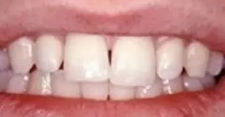 奥齿泰和登腾哪个好？附案例分析和价格表