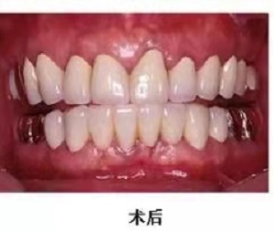 深圳全口种植牙怎么样?内含价格表及案例分析