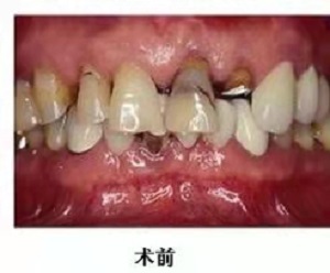 深圳全口种植牙怎么样?内含价格表及案例分析