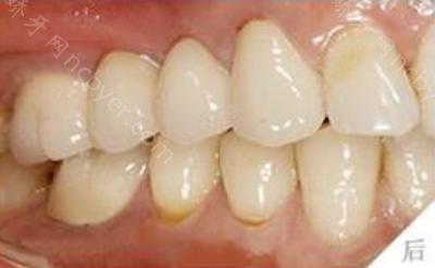 杭州兔牙医口腔医院王红丽牙齿种植案例分享