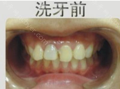 杭州兔牙医口腔医院王红丽洗牙案例分享