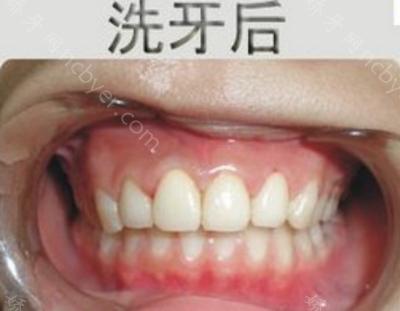 杭州兔牙医口腔医院王红丽洗牙案例分享