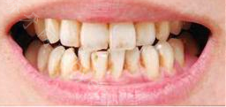重庆医科大学口腔颌面外科牛亚南牙齿正畸矫正真实案例分享