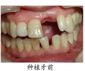 北京瑞泰口腔医院郭航做牙齿种植案例介绍