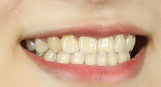 福州晶美口腔门诊部谢宾宾牙齿瓷贴面案例
