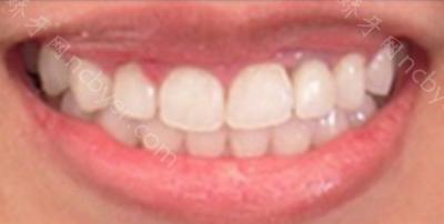 杭州拜博口腔医院高振华牙齿种植案例分享