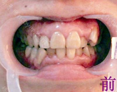 杭州拜博口腔医院高福敏隐形牙齿矫正案例分享