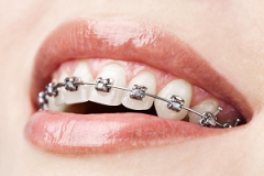牙齿矫正最佳年龄段是什