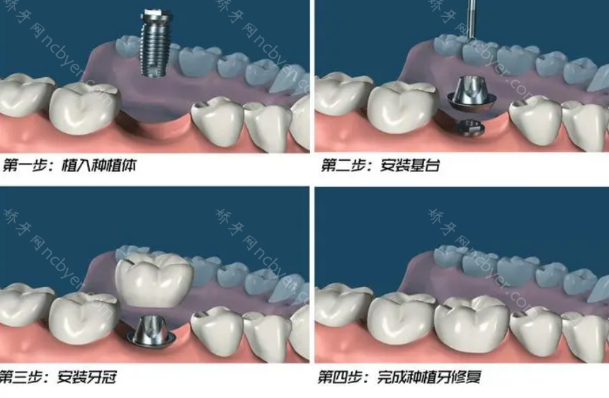 北京碧格口腔诊所收费标准更新：韩系种植牙4500元起，欧美系种植牙7800元起