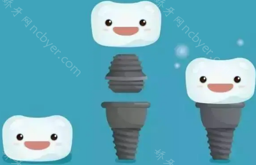 西安种植牙比较好的医院排名：全是公立医院口碑绝佳!