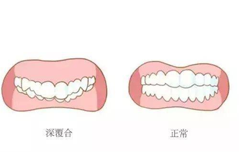 正常的牙齿咬合是什么样的？牙齿咬合的相关知识你了解吗？