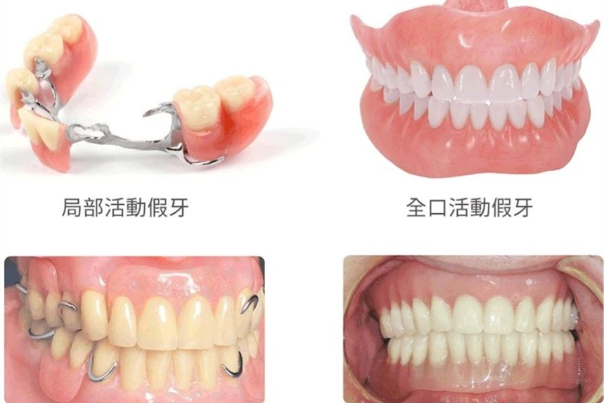 少一颗牙少活10年真的吗？来了解一下我们的口腔健康问题吧
