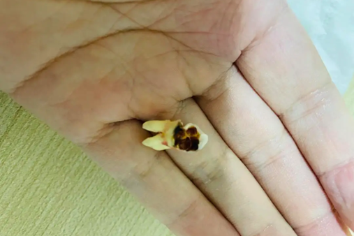 智齿腐蚀剩一半了怎么办？如何治疗智齿腐蚀的口腔问题