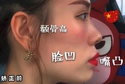 戴牙套1-12个月变化图！脱胎换骨的我重获自信
