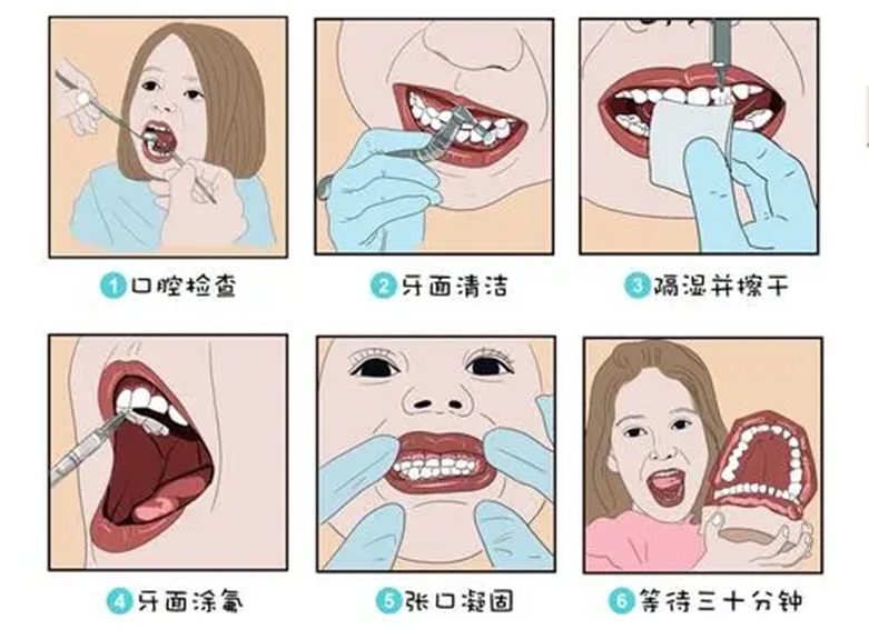 儿童牙齿涂氟有什么好处和坏处?了解之后再决定要不要给孩子涂氟吧