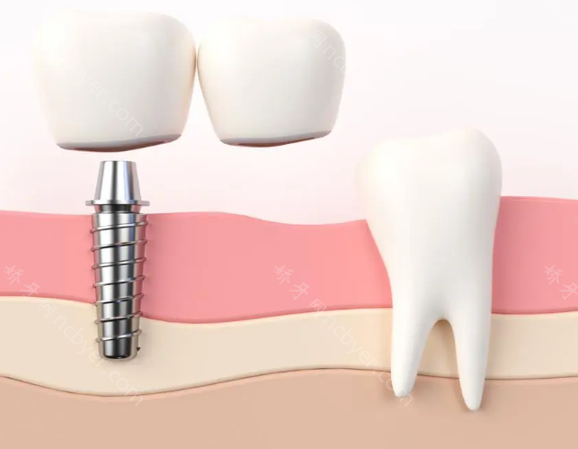 国内做种植牙的口腔医院哪个更专业?哪家植牙更靠谱?附医院介绍