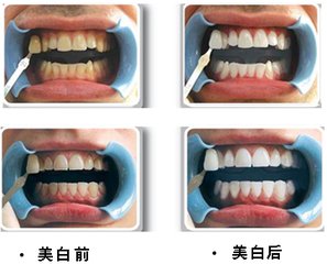 荆门牙齿美白2024价格表:韩国奥齿泰种植牙:900元起/瑞士sic种植牙:2700元起